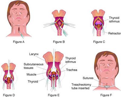 Body piercings, schmody piercings. This will be the next craze.